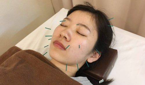 美容鍼灸