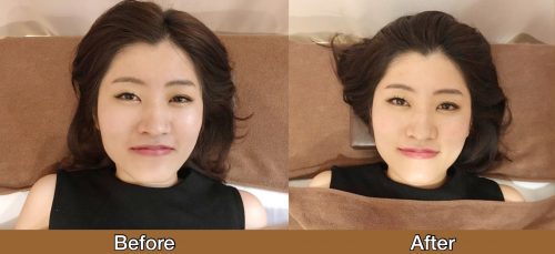 美容鍼灸