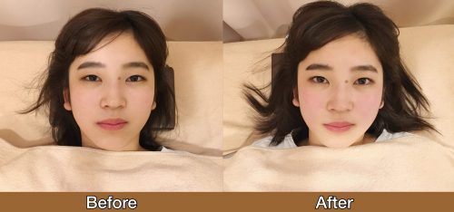 美容鍼灸