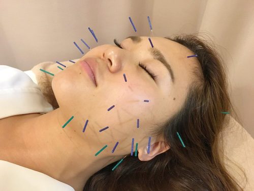 美容鍼灸中