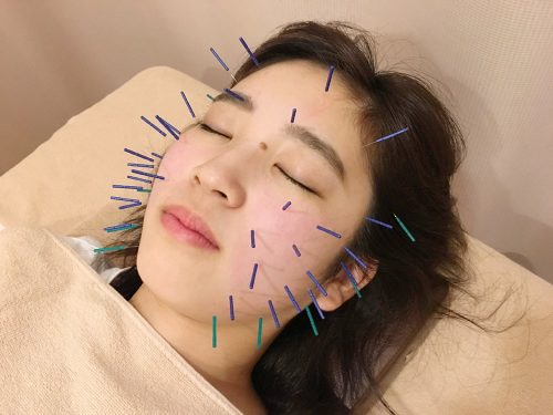 美容鍼灸中