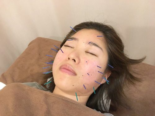 美容鍼灸中