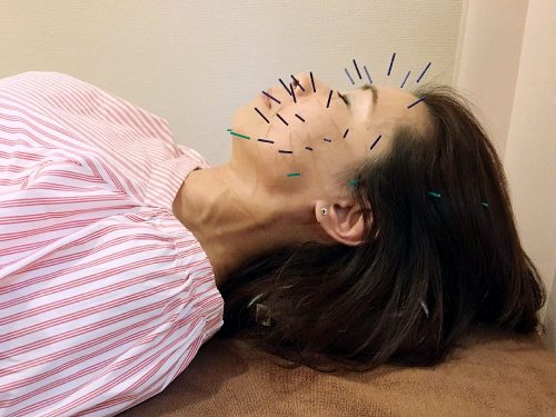 美容鍼灸中